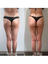 インフィニーズ(INFINEEZ)/カスタマイズ120分痩身脚30代