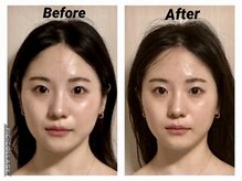 ショウフェイスデザイン(Sho Face Design)/《小顔矯正》ビフォーアフター