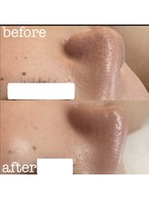 テテアテテ(tete a tete)/脱毛しながら 毛穴悩みも解消☆
