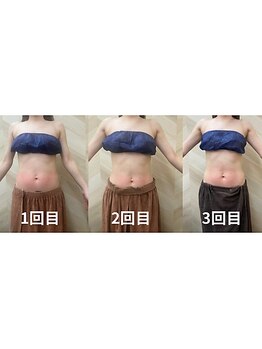 介正鍼灸整骨院 整体院 エフコープ大野城店/痩身エステ＊ラジオ波／キャビ