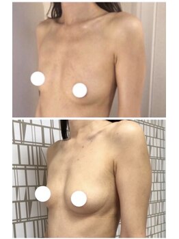 ソラ(sora)/バストアップ・バストケア症例★