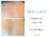 【背中ニキビ】背中のニキビ・毛穴が気になる方へ(上部 or下部) 90分