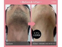 ブロンズ(BRONZE)/