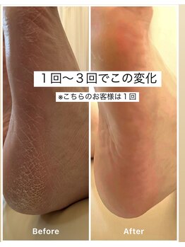 ミシュリーヌ(micheline.)/べべケアスパ/角質除去