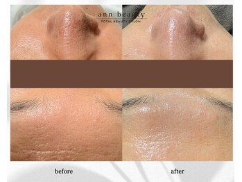 アン ビューティー(ann beauty)/施術6回【症例写真】