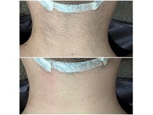 毛穴・脱毛・痩身