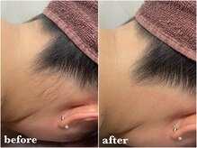 レフィナドール(Refinador)/全身脱毛(顔・VIO込)初回¥10,000