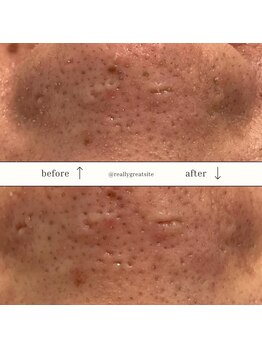 ザ カリビア(The CAREBEA)/毛穴洗浄☆ハイドロスプラッシュ