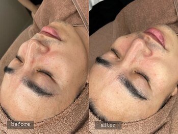 ラナン 恵比寿店(Ranun)/before/after ★ララピール