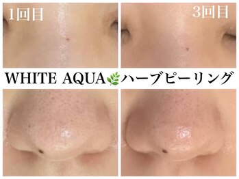 ホワイトアクア 福岡天神店(WHITE AQUA)/ハーブピーリング1回~3回