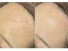 【敏感肌・ゆらぎ肌に】乳酸菌の力で内側から整う透明感ケア"アンストレス"