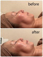 リリィ(RIRY)/フェイシャル　ビフォーアフター