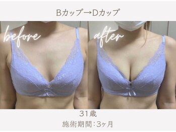 ハリスタ 京橋院(HARISTA)/BEFORE AFTER【バストアップ】