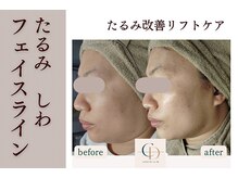 サロンドコーデ(salon de co-de)の雰囲気（【リフトアップ/エイジングフェイシャル】たるみ改善しわくすみ）