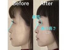 ラプリ 大宮店(Raplit)/隆鼻＋輪郭矯正40分10回