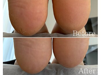 カシェット 広島店(Cachette)/40代女性☆足裏角質ケア60分