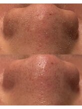 ヒミー(himee)/毛穴洗浄＋艶肌ハーブピーリング