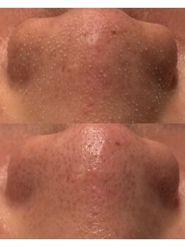 ヒミー(himee)/毛穴洗浄+艶肌ハーブピーリング