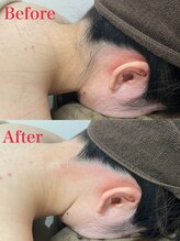 ミース 越谷店/うなじ矯正●Before After