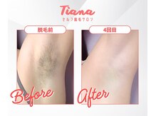 ティアナ 和歌山県庁前店(Tiana)/ワキ脱毛　Before&After