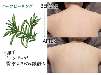 キレイベース 銀座店(KIREI BASE)/ハーブピーリング(背中) 1回