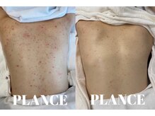 プランス 恵比寿店(PLANCE)/背中ざらつき/恵比寿エステ