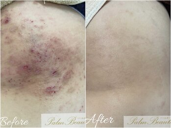 パームボーテ(Palm Beaute)/幼少期からのお悩みゆらぎ肌