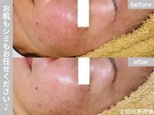 サロン ビュー(salon view)/40代女性〈シミ悩み〉　