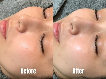 パール エビス(Pearl Ebisu)/ハーブピーリング｜ツヤ肌