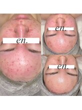 エン(en.)/ニキビ改善