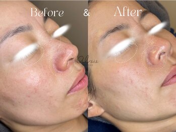 アイシス(AIsis)/赤み・シワ【5ヶ月】