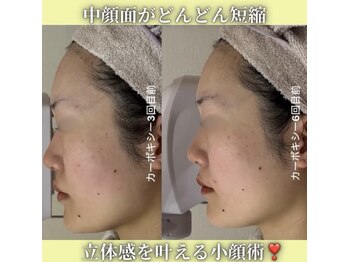 ハニエル(Haniel)/カーボキシー症例