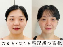 ジョンミー(JONMEE)の雰囲気(毛穴縮小には韓国最新ダクトピール!銀座一丁目.東銀座.宝町)