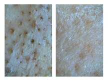 ケアナケア 守谷/まずは自分の素肌を知ること