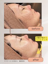 モモ(momo)/まるで糸リフト！？