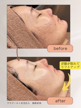 モモ(momo)/まるで糸リフト！？