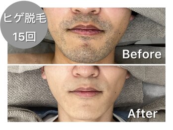 ナルシス/【ヒゲ脱毛】15回の変化★