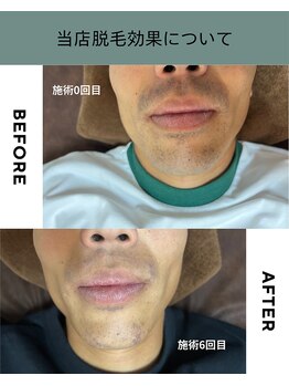 ジェントル 三宮/都度払い専門メンズ脱毛サロン