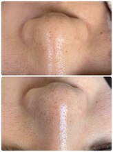 シエルボーイ(Cielboy)/毛穴の大掃除でスッキリ