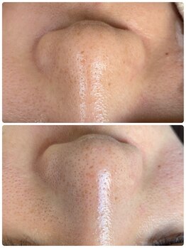 シエルボーイ(Cielboy)/毛穴の大掃除でスッキリ