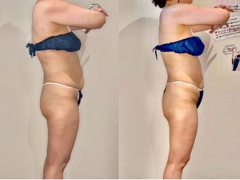 カルナ(CARNA)/【痩身】セルライトゼロ2