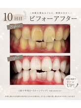 ホワイト 上乃木南店(WHITE)/ 10回目ビフォーアフター