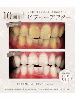 ホワイト 上乃木南店(WHITE)/ 10回目ビフォーアフター