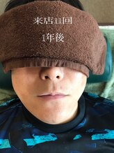 メンズ脱毛 3110R/1/