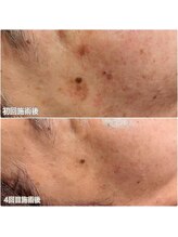エクレット/【シミケア】お客様の変化