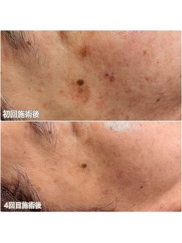 エクレット/【シミケア】お客様の変化