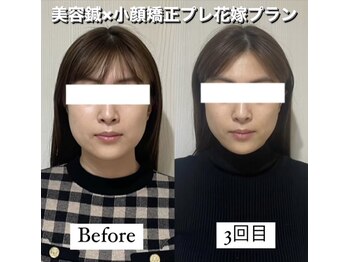 ハリカ 恵比寿 代官山店(HARIKA)/小顔矯正で癖になるスッキリ感を