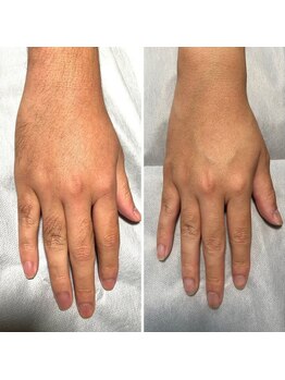 ティエル(TieLu)/手の甲