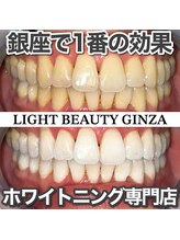 ライトビューティー 銀座店(LightBeauty)/東銀座 ホワイトニング症例写真