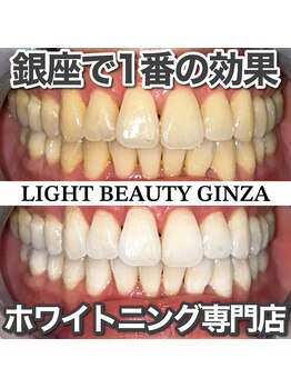 ライトビューティー 銀座店(LightBeauty)/東銀座 ホワイトニング症例写真